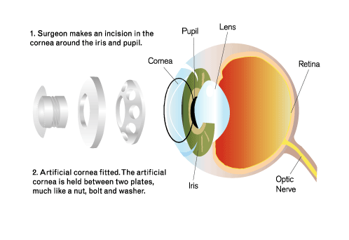 Cartoon of an artificial cornea