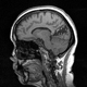 Visual Plasticity After Brain Damage
