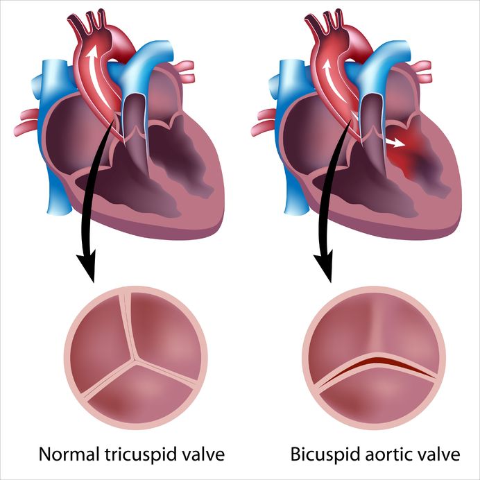 Bicuspid Aortic Valve