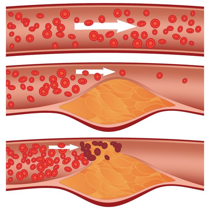 Example of atherosclerosis, clotting, arteries