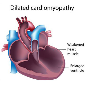 Dilated Cardiomyopathy