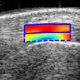 Modulation of Insertional Achilles Tendinopathy by Multiaxial Mechanical Strains