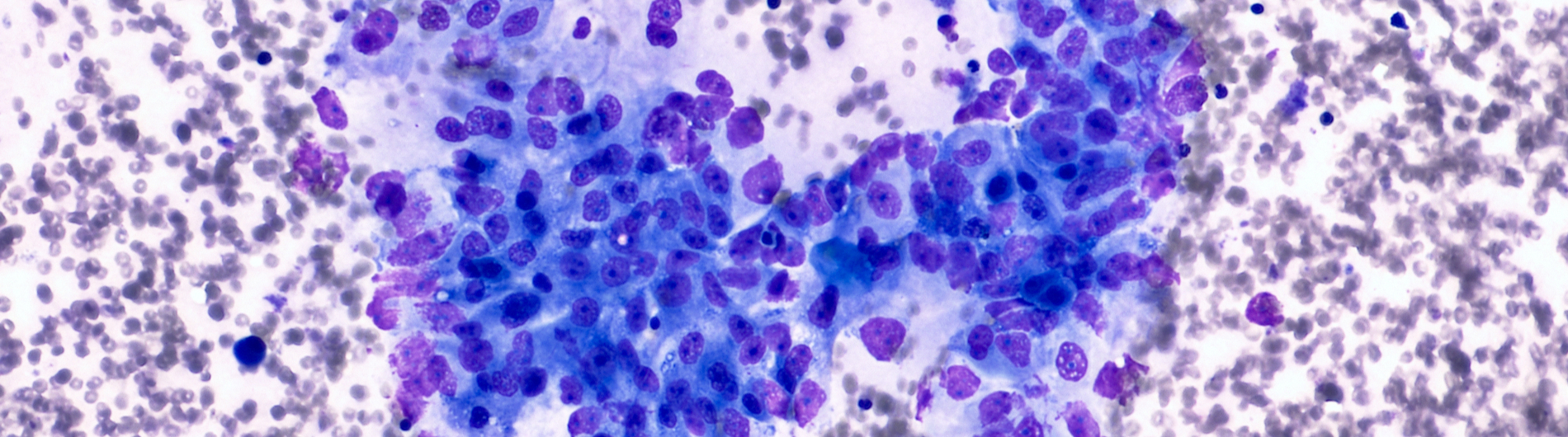 pancreatic cancer cell photo