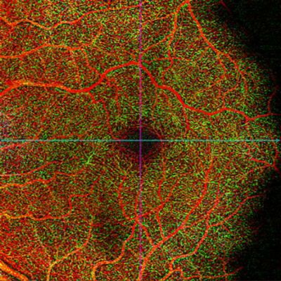 eye scan macular cube image