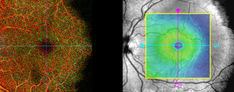 eye scan macular cube image