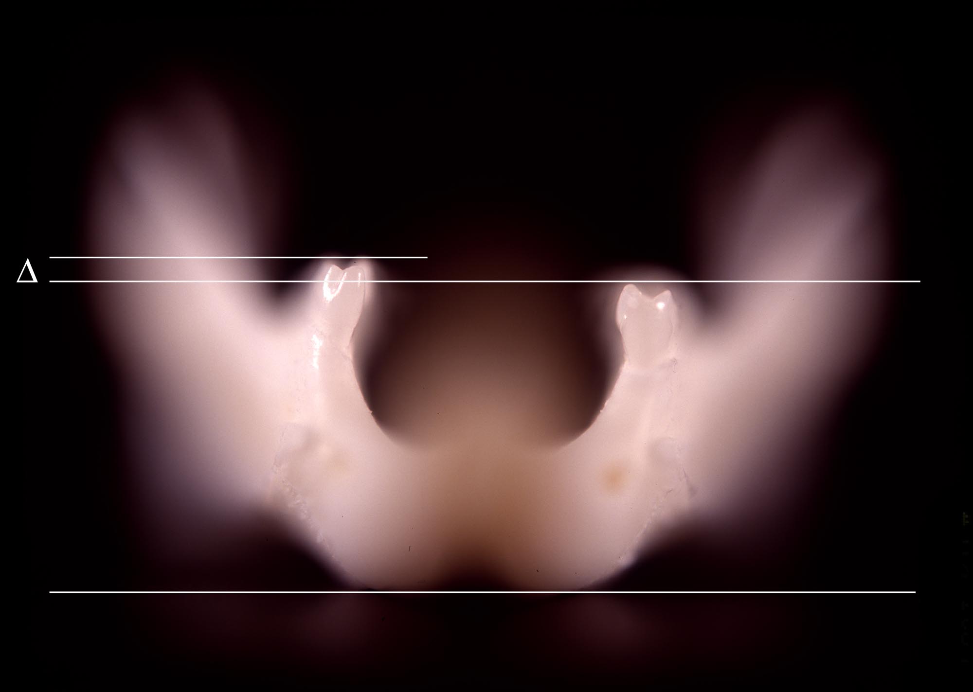 A model of a jaw with horizontal lines measuring the difference in height between teeth on either side.
