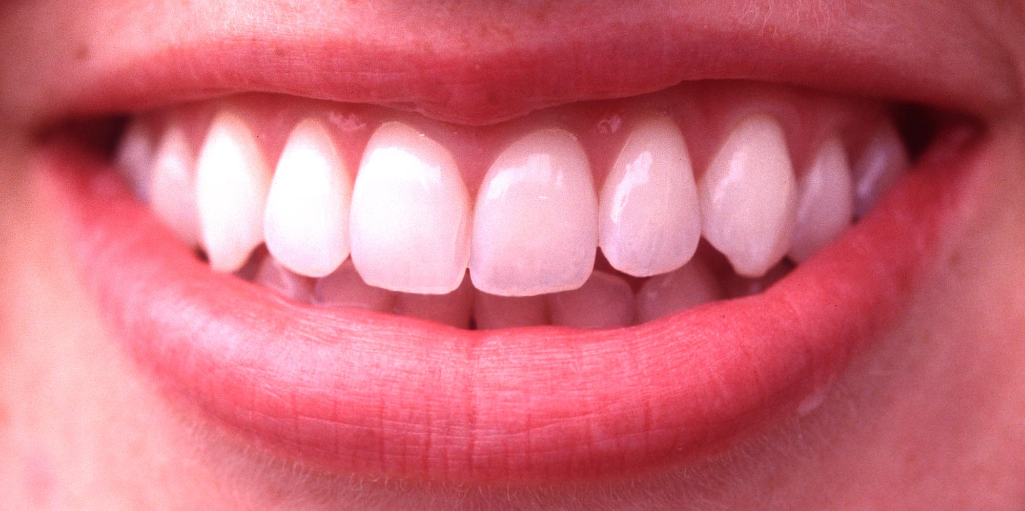 A smiling mouth with straight, healthy teeth.