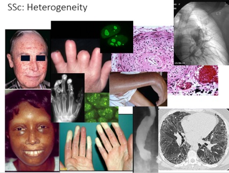 Heterogeneity of Scleroderma