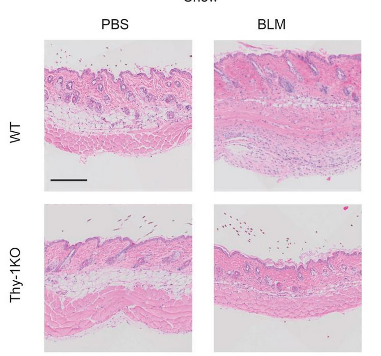 iii.	Fibroblast Heterogeneity and the Role of CD90 (Thy-1) in Skin Fibrosis in Scleroderma