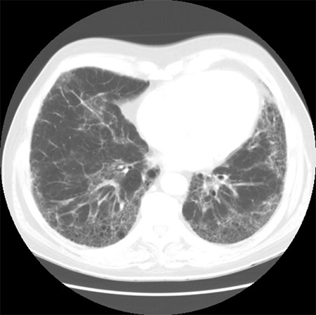 CT of Lungs demonstrating diffuse scarring