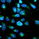Roles of bladder cancer tumor derived extracellular vesicles in metastasis