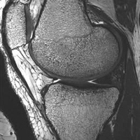 MR Image of the knee