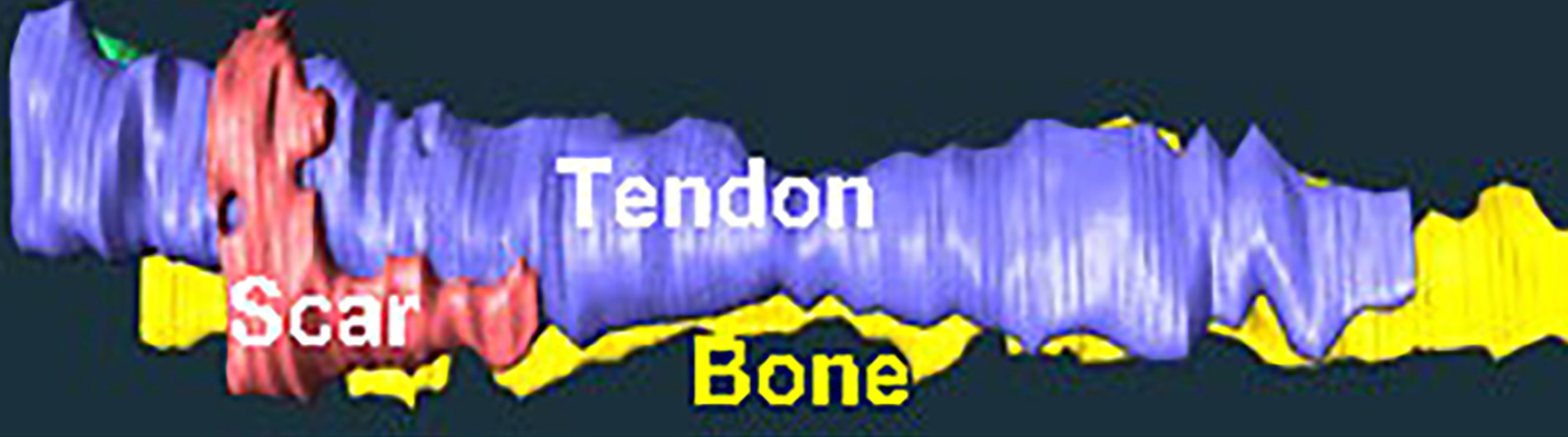 3D Reconstruction: Tendon, Bone, Scar