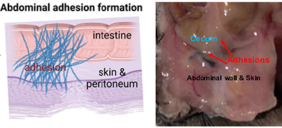 Abdominal Adhesion Formation