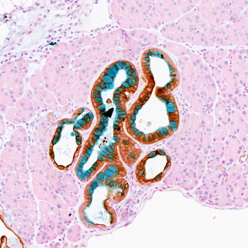 Pancreatic ductal adenocarcinoma (PDAC)