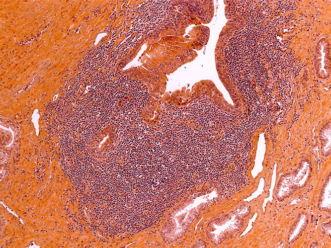 100x picture showing an ectopic lymphoid structure in prostate of individual with prostate intraepithelial neoplasia.