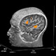 Pre-surgical mapping of language and motor networks using task and resting state fMRI