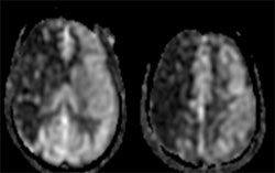 Cerebral Blood Flow map obtained with ASL in a patient with right ICA/MCA stenosis
