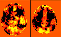 Cerebral Vascular Reactivity map obtained with BOLD fMRI in the same patient