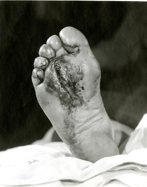 Diabetic infection, foot