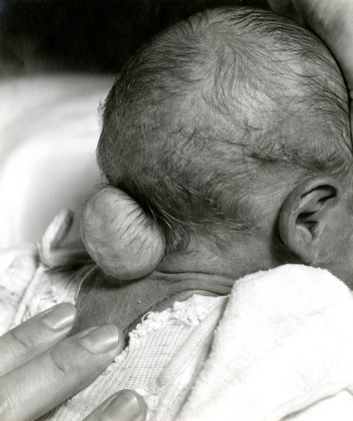 Photograph of infant with meningocele