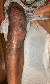 Physical exam revealed a large hyperpigmented plaque with several erosions, overlying scale, and desquamation over the right anterior and medial thigh extending to the lower leg.