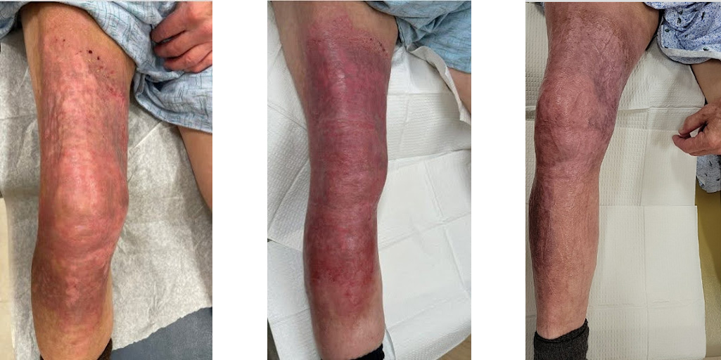 The offending topicals were stopped and a gentle skin care regimen was initiated, consisting of plain petrolatum jelly covered with gauze. At his 3 month follow up visit (FUV): we saw resolution of the hyperpigmentation and scale. At his 4 month FUV: the patch was smooth, red, and erythematous. By his 6 month FUV: we saw resolution of the erythema with some residual post-inflammatory hyperpigmentation.