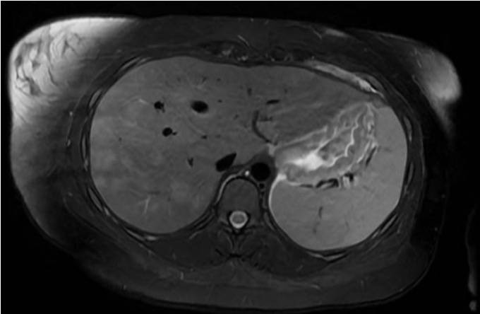 Figure 1: Hepatic MRI demonstrating multiple liver lesions