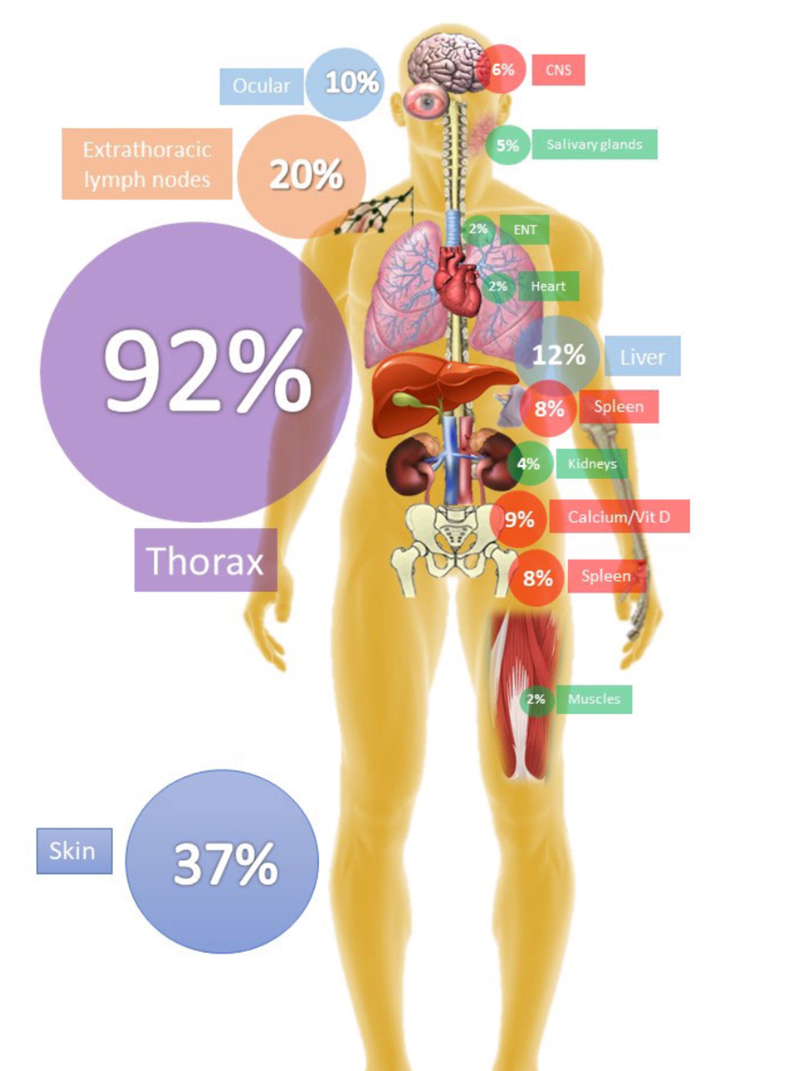 Depiction of human body with percentages of occurrence of sarcoidosis: 92% thorax, 37% skin, 20% extrathoracic lymph nodes, 12% liver, 10% ocular, 9% calcium/vit D, 8% spleen, 6% CNS, 5% salivary glands, 4% kidneys, 2% muscles, 2% heart, 2% ENT