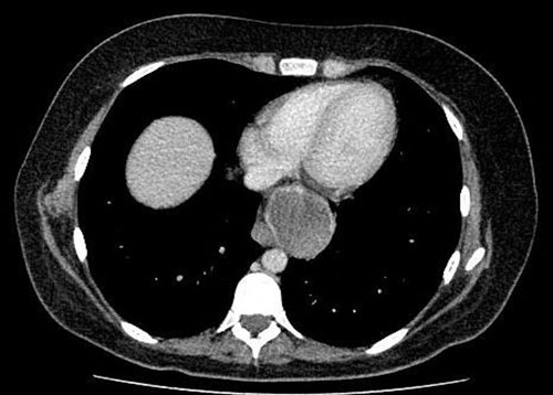 CT Chest demonstrating 5.4 cm collection into posterior mediastinum