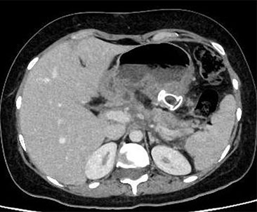 CTAP demonstrating 'AXIOS' stent insitu, resolution of Mediastinal Collection Replacement by Hiatal hernia
