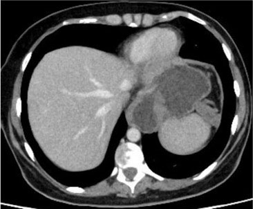 CTAP demonstrating 'AXIOS' stent insitu, resolution of Mediastinal Collection Replacement by Hiatal hernia