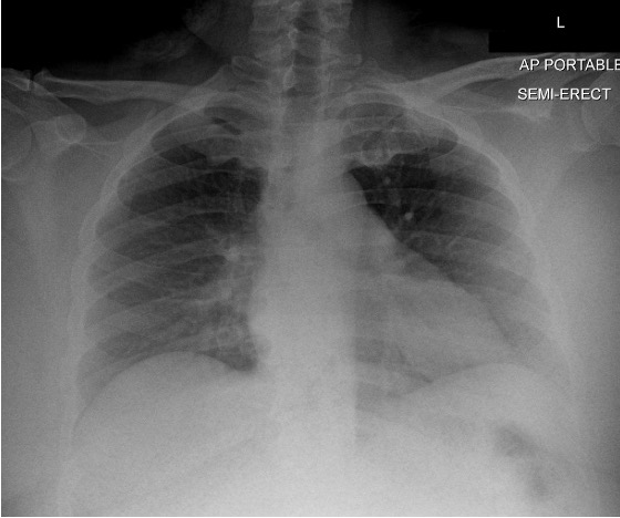 Patient's chest Xray