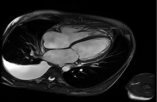 Figure 2: CMR short-axis image demonstrating a dilated left ventricle with global hypokinesis and reduced systolic function. The right ventricle is also dilated with reduced contractility. No delayed gadolinium enhancement is present, suggesting absence of myocardial fibrosis and supporting a reversible non-ischemic cardiomyopathy. T2 mapping findings showed myocardial iron quantification consistent with hemochromatosis.