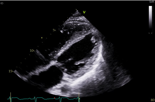 Figure 3: Transthoracic echocardiography demonstrating a mildly dilated left ventricle with severely reduced ejection fraction and global systolic dysfunction, with associated biatrial enlargement and right ventricular dilation. Follow up at 6 months after guideline directed medical therapy and iron reduction therapy demonstrates recovery of LVEF to 49% with mild residual global dysfunction.