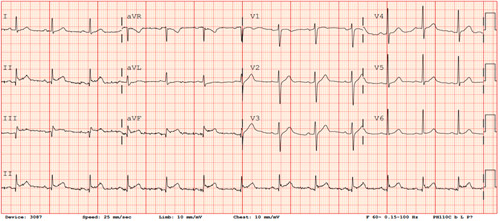 Electrocardiogram With Inferior STEMI