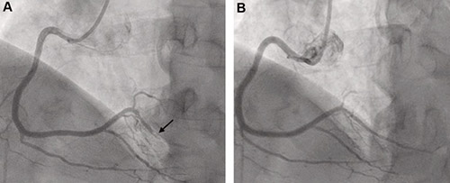 Coronary Angiography Demonstrating Acute Thrombotic Occlusion Without Significant Atherosclerosis