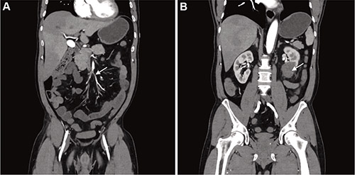 Computed Tomography Angiography Revealing Superior Mesenteric and Left Renal Artery Thrombosis
