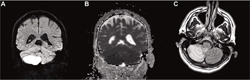 Brain Magnetic Resonance Imaging Showing Right Posterior Inferior Cerebellar Artery Territory Infarction