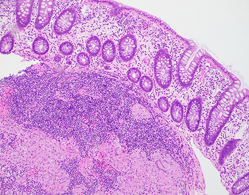 Histopathology revealed non-necrotizing granulomas, consistent with her history of sarcoidosis. Stains for microorganisms was negative, and no dysplasia or malignancy was found.
