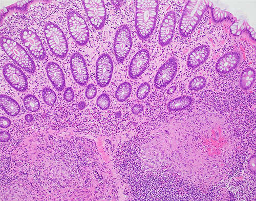 Histopathology revealed non-necrotizing granulomas, consistent with her history of sarcoidosis. Stains for microorganisms was negative, and no dysplasia or malignancy was found.