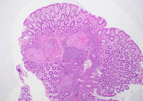 Histopathology revealed non-necrotizing granulomas, consistent with her history of sarcoidosis. Stains for microorganisms was negative, and no dysplasia or malignancy was found.