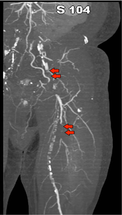 CT angiography shows occlusion of the left femoral arterial system