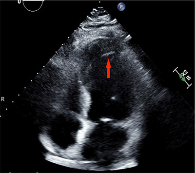 Transthoracic echocardiogram reveals reduced ejection fraction (~35%) with a large left ventrical apical thrombus