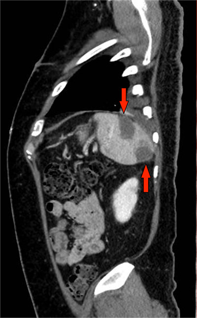 CT angiography shows splenic and renal infarcts