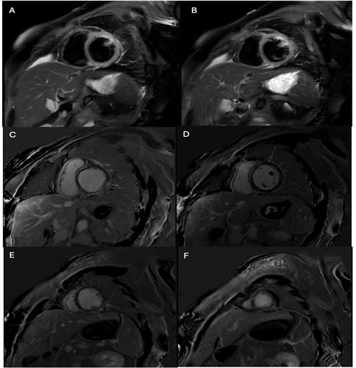 A-B. Hyperintensity seen on sagittal short-axis view T2 Dixon-Based Fat suppression. C-F. Hyperintensity seen on sagittal short-axis view Steady-state Post-contrast Myocardial Delayed Enhancement.