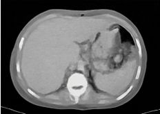 CT scan of abdomen showing cholelithiasis without acute cholecystitis, mild colitis, cirrhotic liver, large-volume ascites