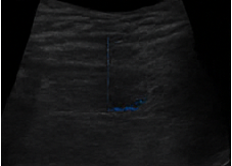 Doppler ultrasound showing possible stenosis