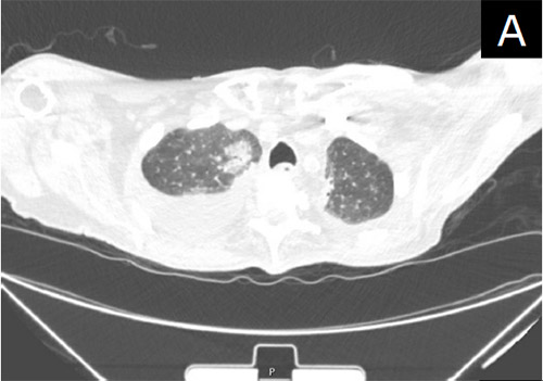 Figure A. Axial Chest CT. Pleural effusion and Upper lobe consolidation on right.