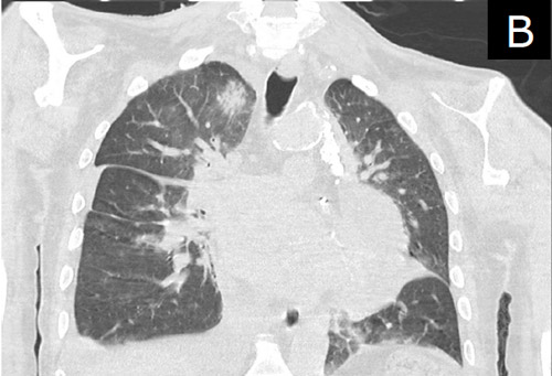 Figure B. Coronal CT Chest. Redemonstration of upper lobe consolidation of right.